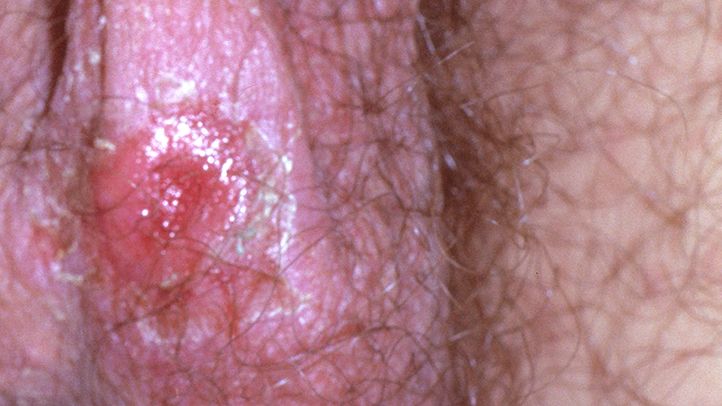 yeast infection sores on vag
